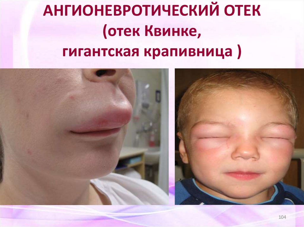 АНГИОНЕВРОТИЧЕСКИЙ ОТЕК (отек Квинке, гигантская крапивница )