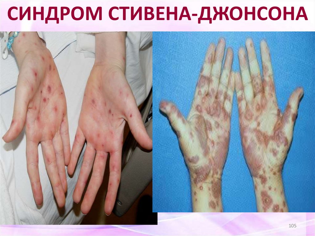 СИНДРОМ СТИВЕНА-ДЖОНСОНА