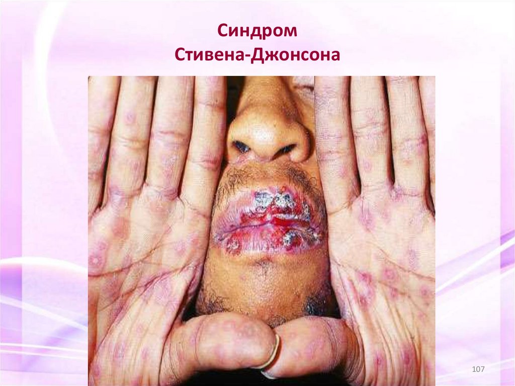Синдром Стивена-Джонсона