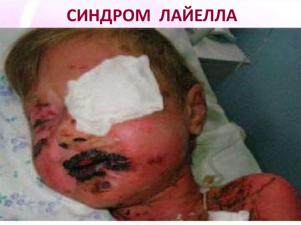 СИНДРОМ ЛАЙЕЛЛА