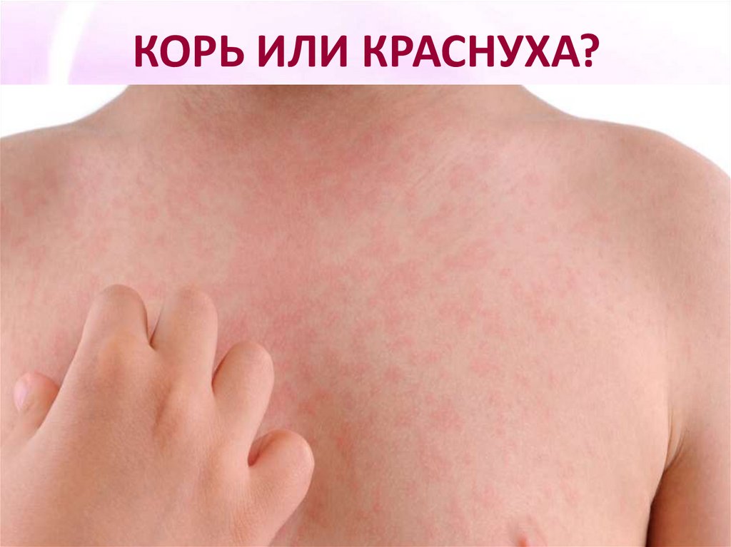 КОРЬ ИЛИ КРАСНУХА?