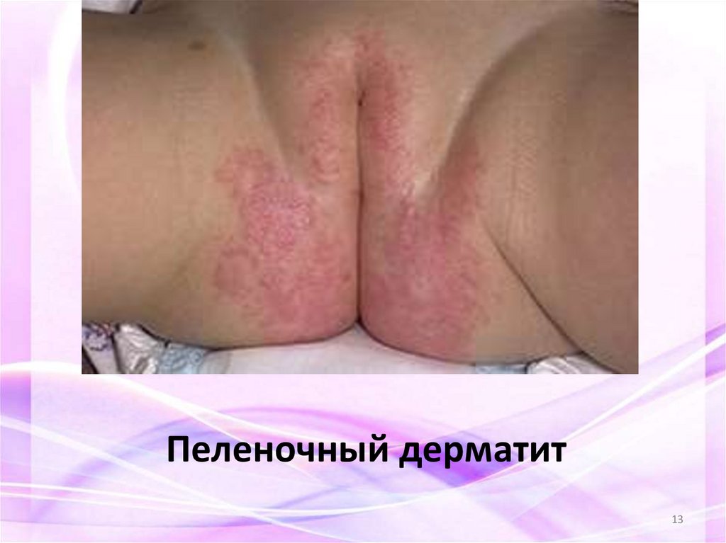 Пеленочный дерматит