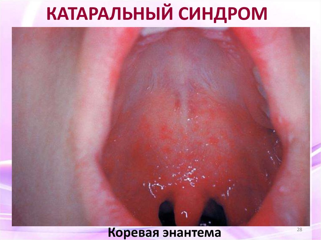 Коревая энантема