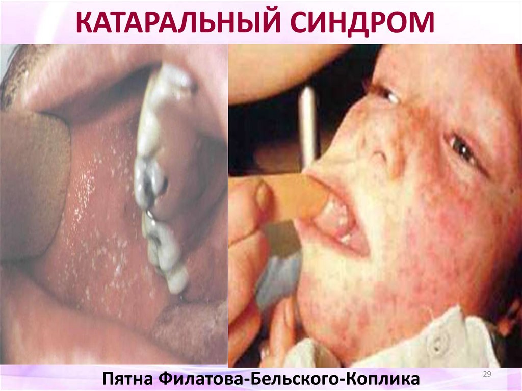 Пятна Филатова-Бельского-Коплика