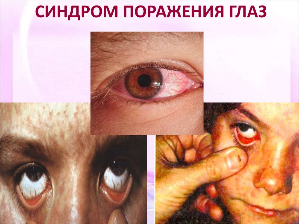 СИНДРОМ ПОРАЖЕНИЯ ГЛАЗ