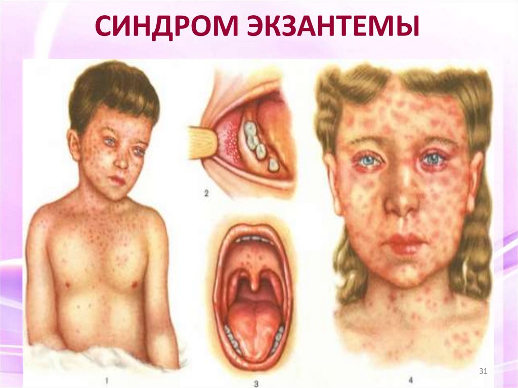 СИНДРОМ ЭКЗАНТЕМЫ