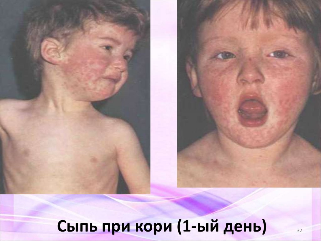 Сыпь при кори (1-ый день)
