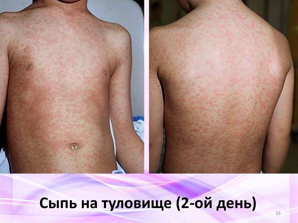 Сыпь на туловище (2-ой день)