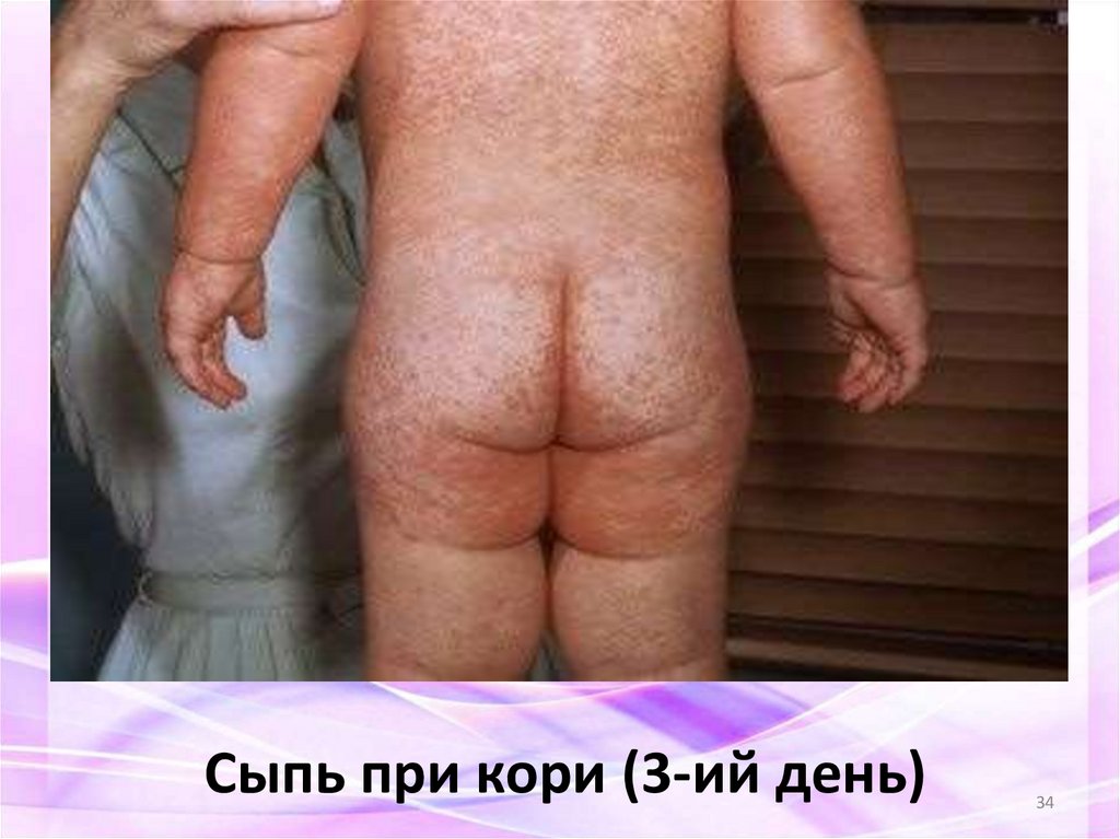 Сыпь при кори (3-ий день)