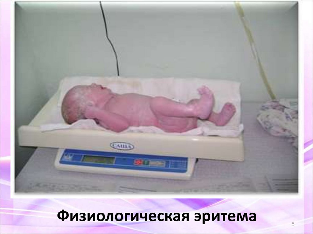 Физиологическая эритема