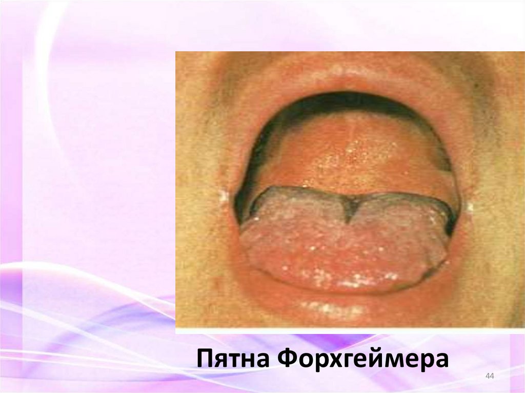 Пятна Форхгеймера