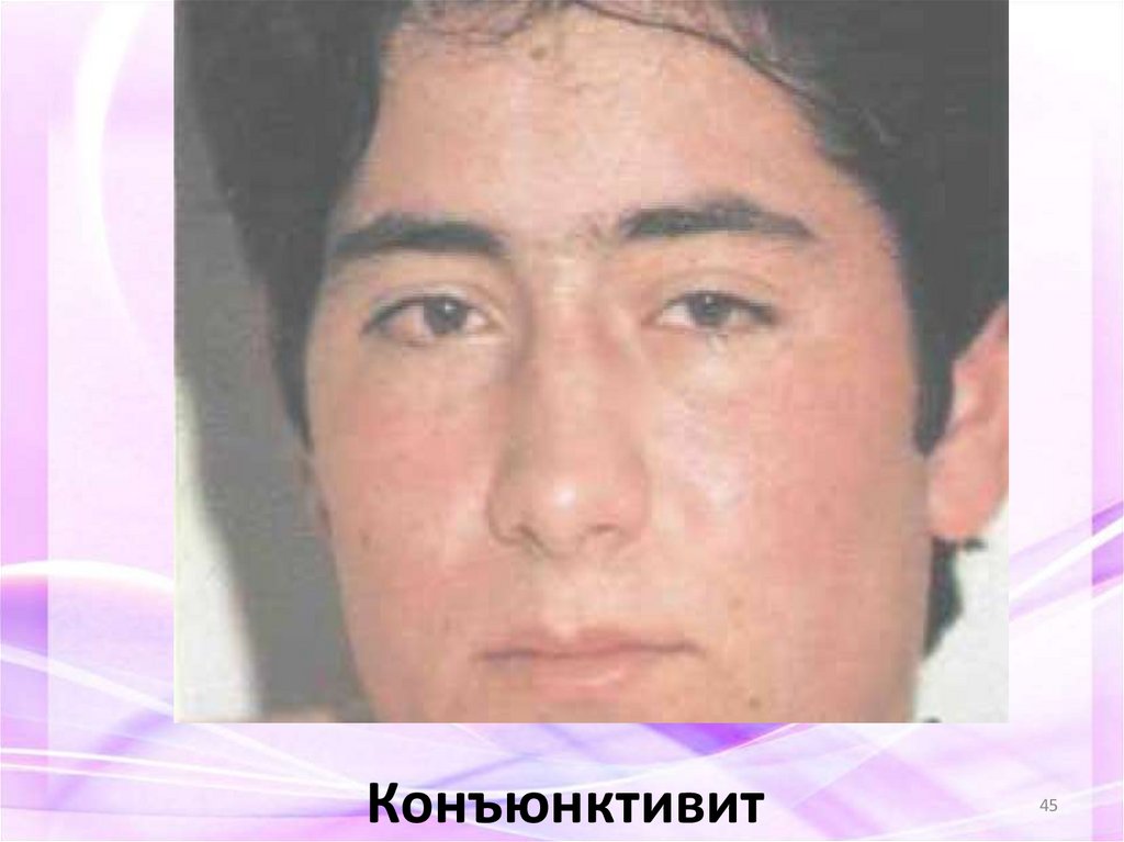 Конъюнктивит