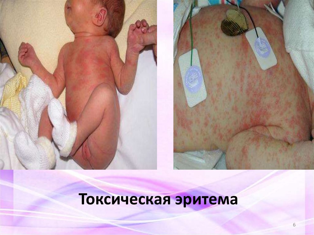 Токсическая эритема