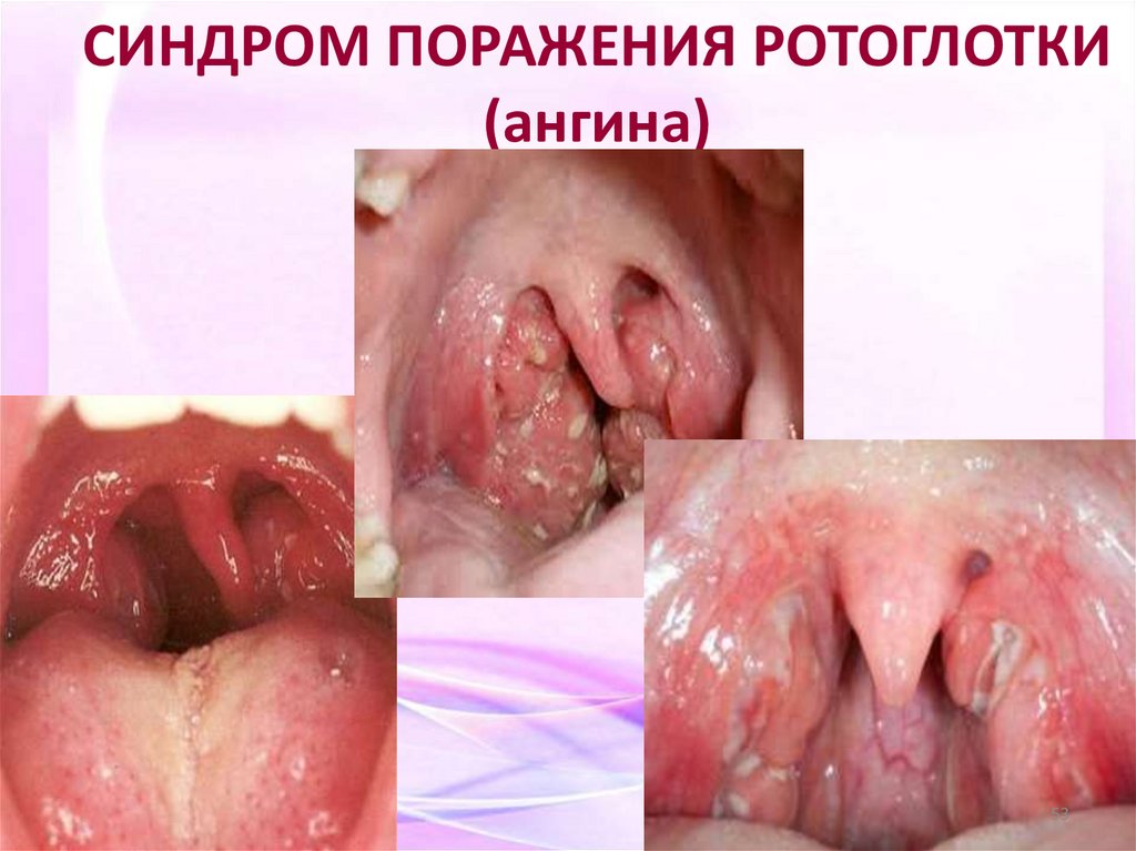 СИНДРОМ ПОРАЖЕНИЯ РОТОГЛОТКИ (ангина)