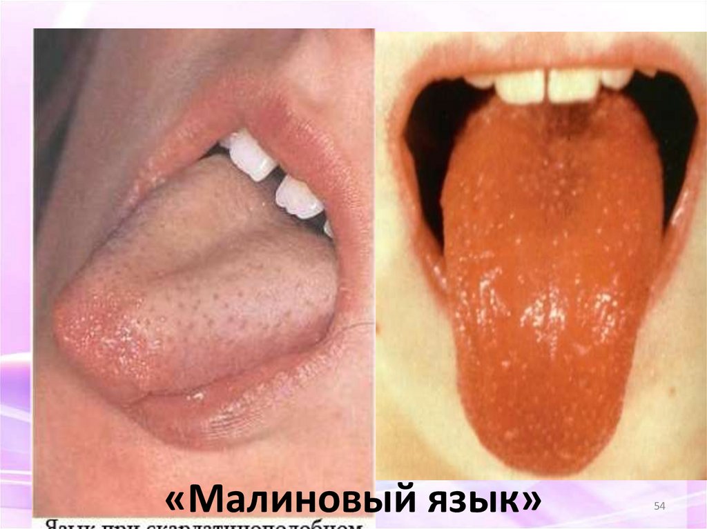 «Малиновый язык»