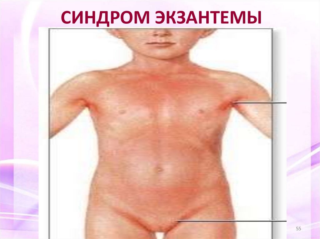 СИНДРОМ ЭКЗАНТЕМЫ