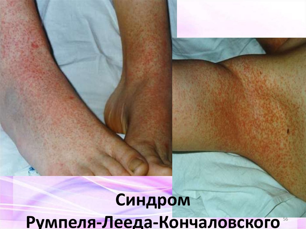 Синдром Румпеля-Лееда-Кончаловского