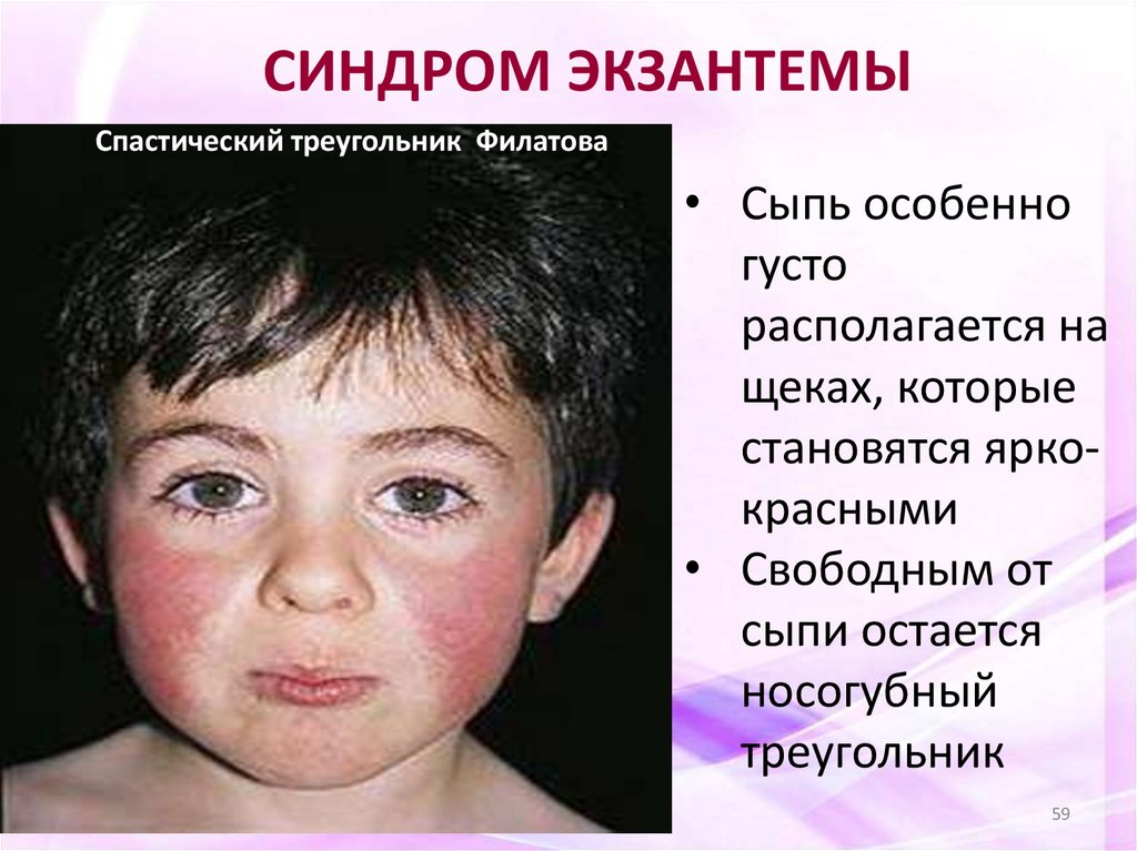 СИНДРОМ ЭКЗАНТЕМЫ