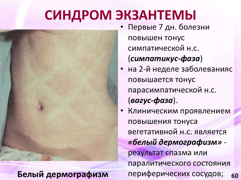 СИНДРОМ ЭКЗАНТЕМЫ