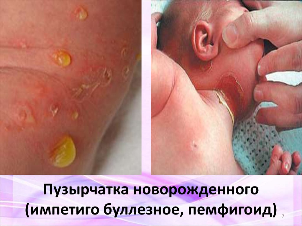 Пузырчатка новорожденного (импетиго буллезное, пемфигоид)