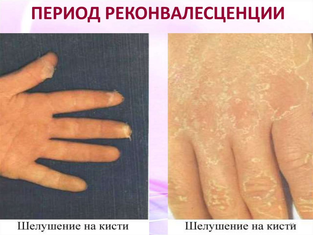 ПЕРИОД РЕКОНВАЛЕСЦЕНЦИИ
