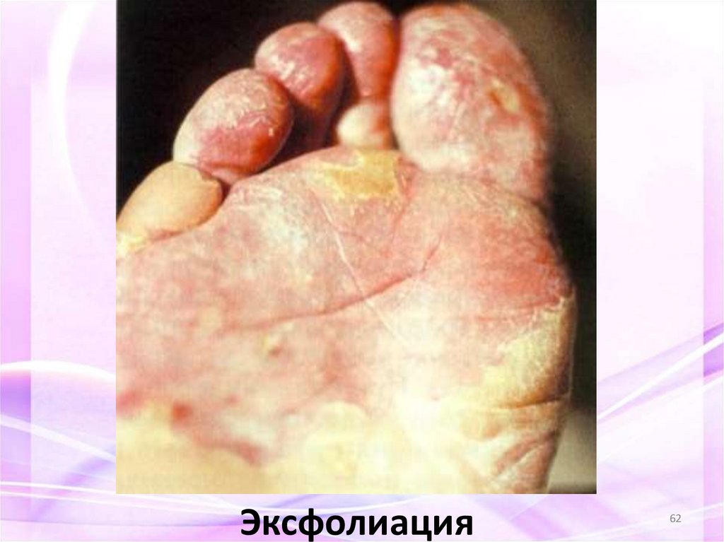 Эксфолиация