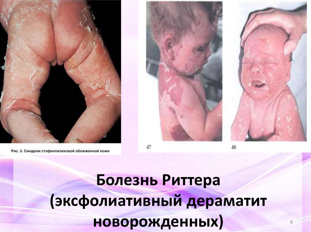 Болезнь Риттера (эксфолиативный дераматит новорожденных)