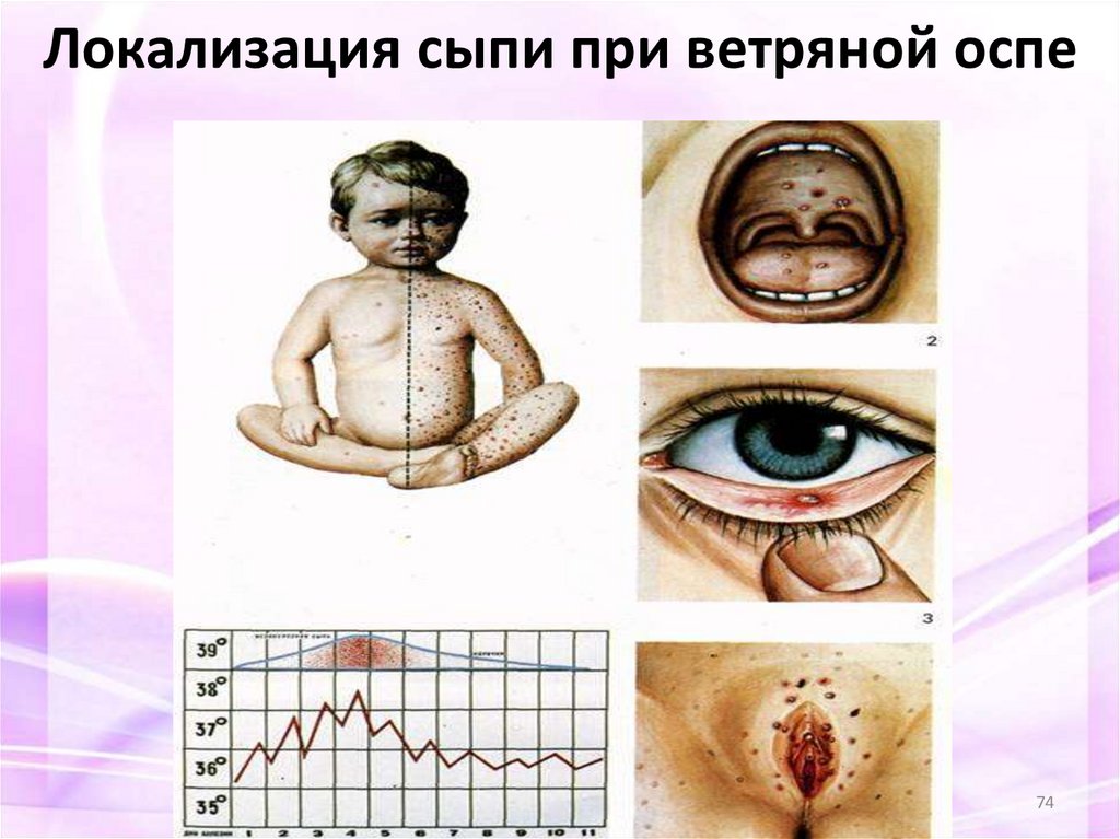 Локализация сыпи при ветряной оспе