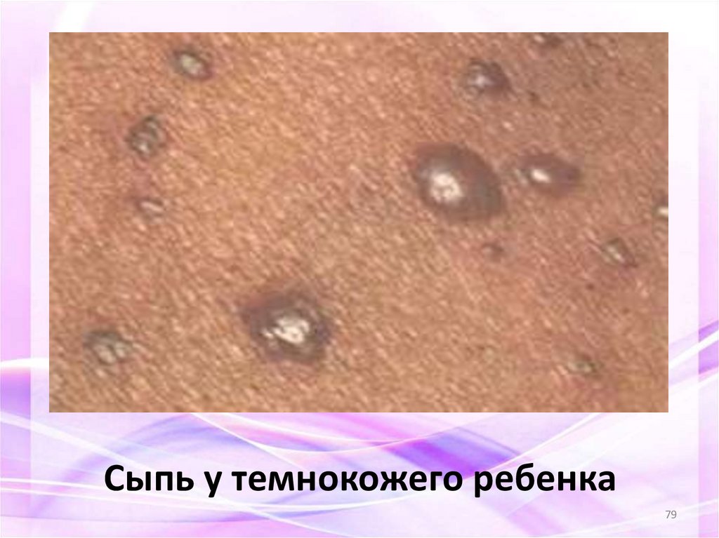 Сыпь у темнокожего ребенка