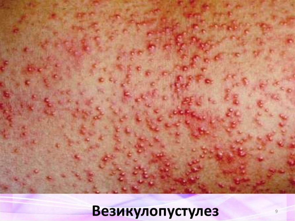 Везикулопустулез