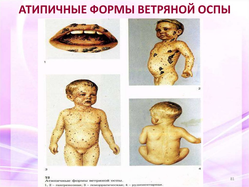 АТИПИЧНЫЕ ФОРМЫ ВЕТРЯНОЙ ОСПЫ