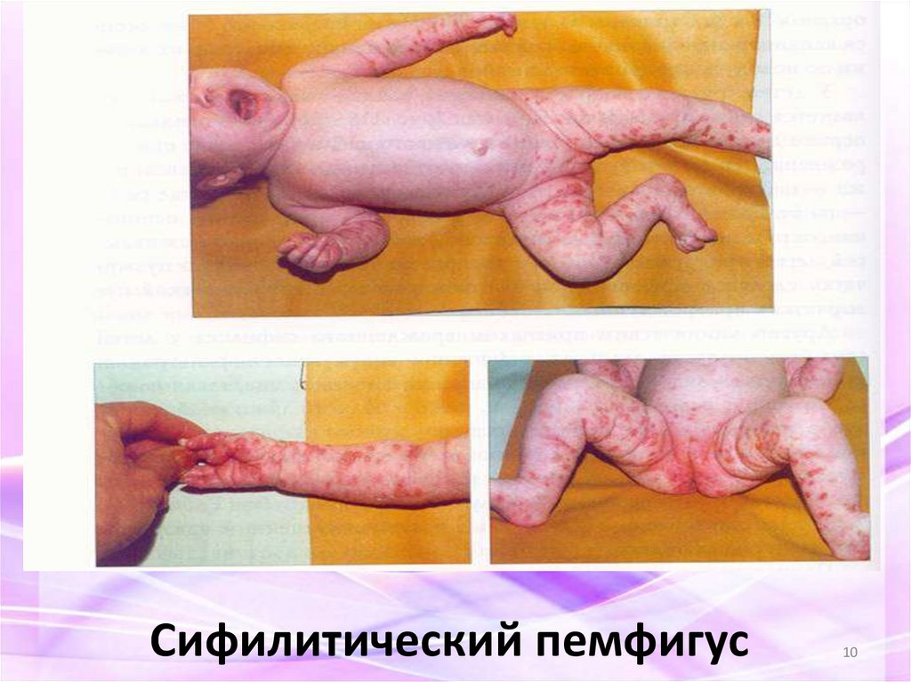 Сифилитический пемфигус