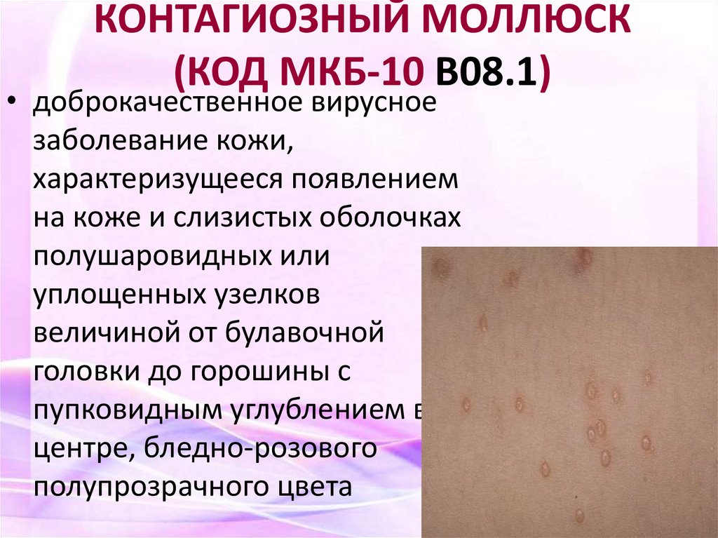 КОНТАГИОЗНЫЙ МОЛЛЮСК (КОД МКБ-10 В08.1)