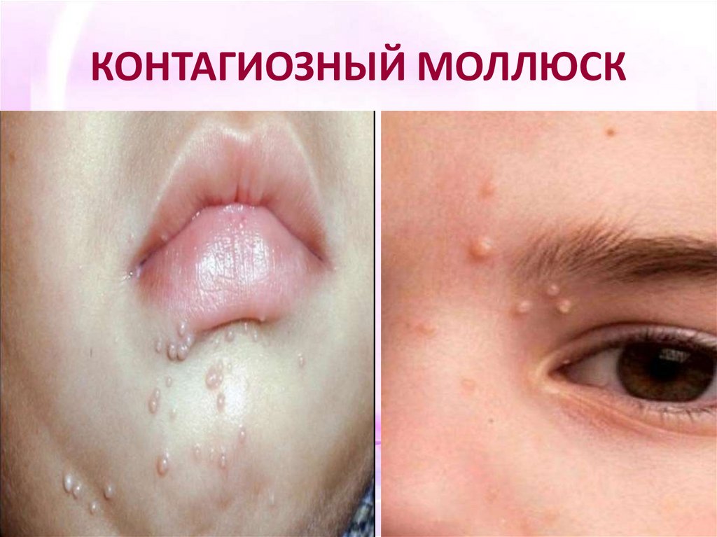 КОНТАГИОЗНЫЙ МОЛЛЮСК
