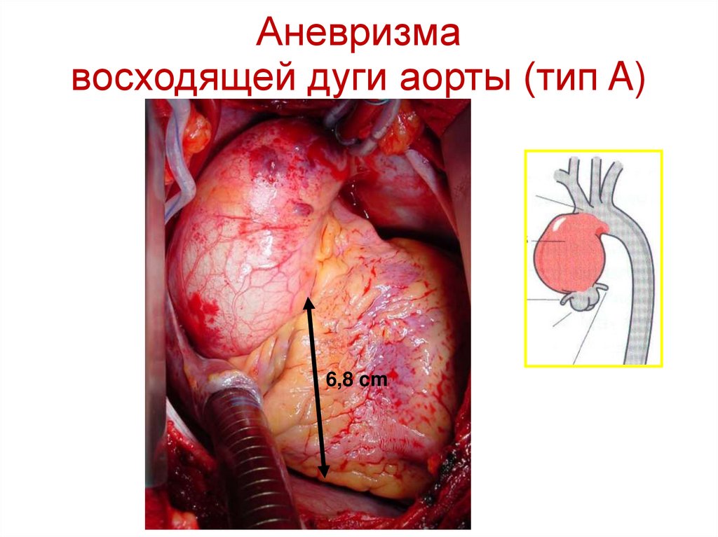 Аневризма восходящей дуги аорты (тип A)