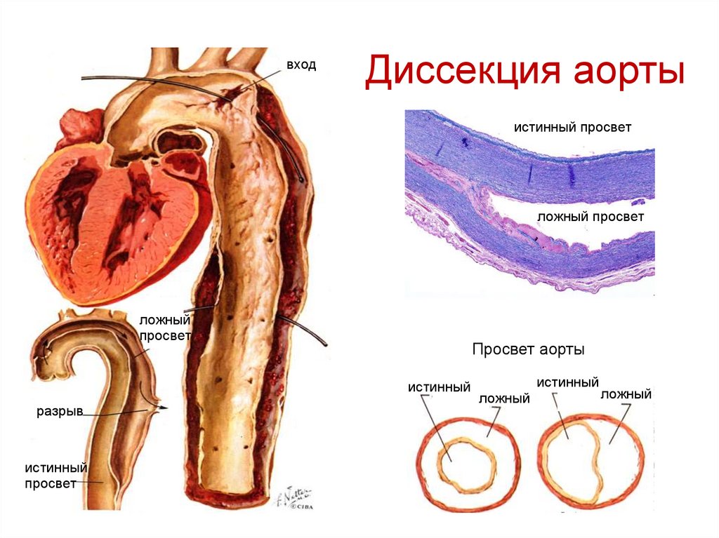Диссекция аорты