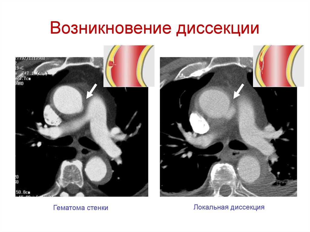Возникновение диссекции