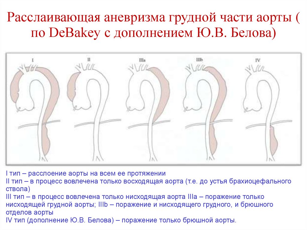 Расслаивающая аневризма грудной части аорты ( по DeBakey с дополнением Ю.В. Белова)