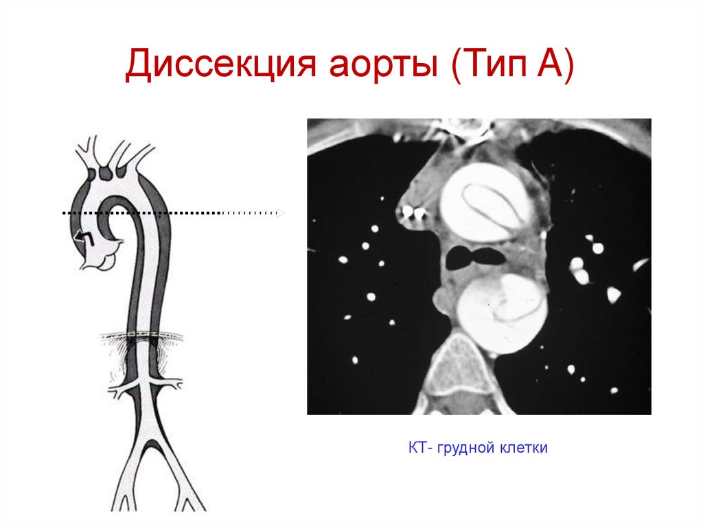 Диссекция аорты (Тип A)