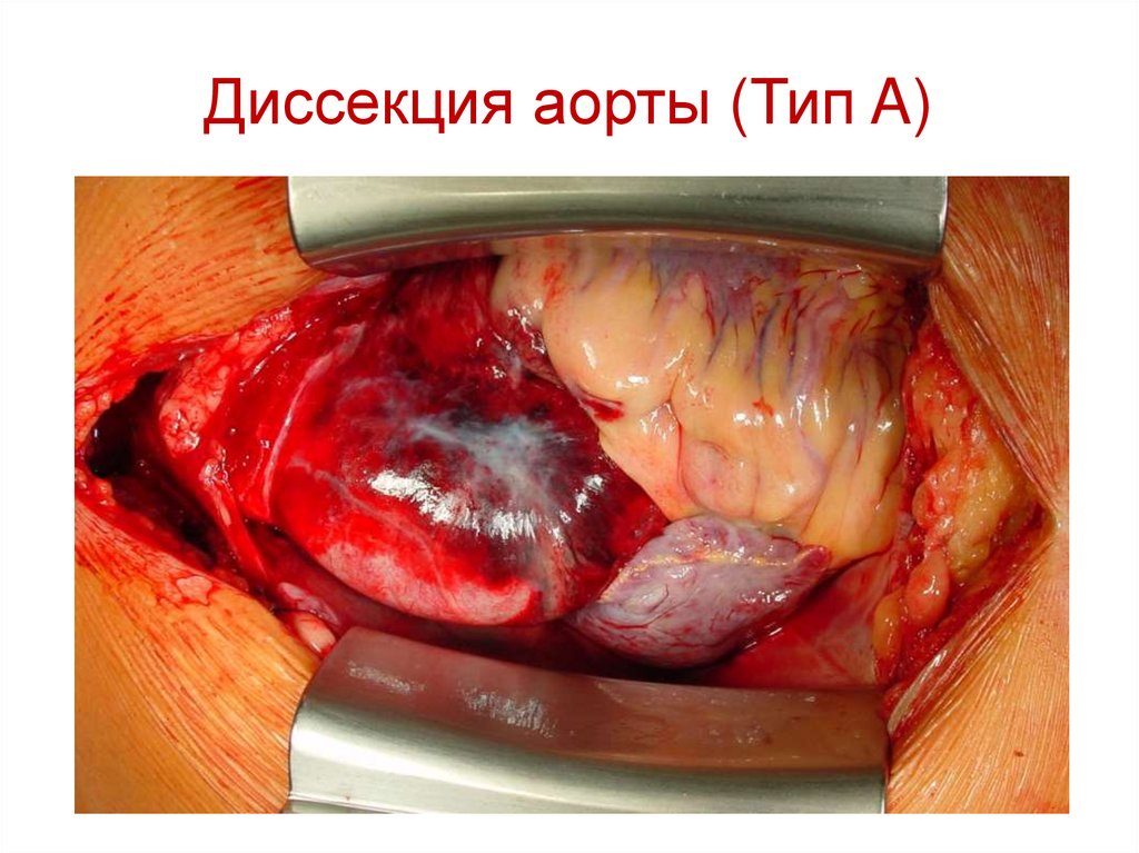 Диссекция аорты (Тип A)