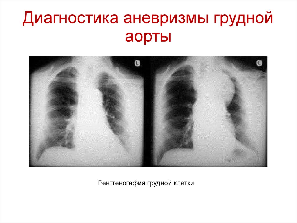 Диагностика аневризмы грудной аорты