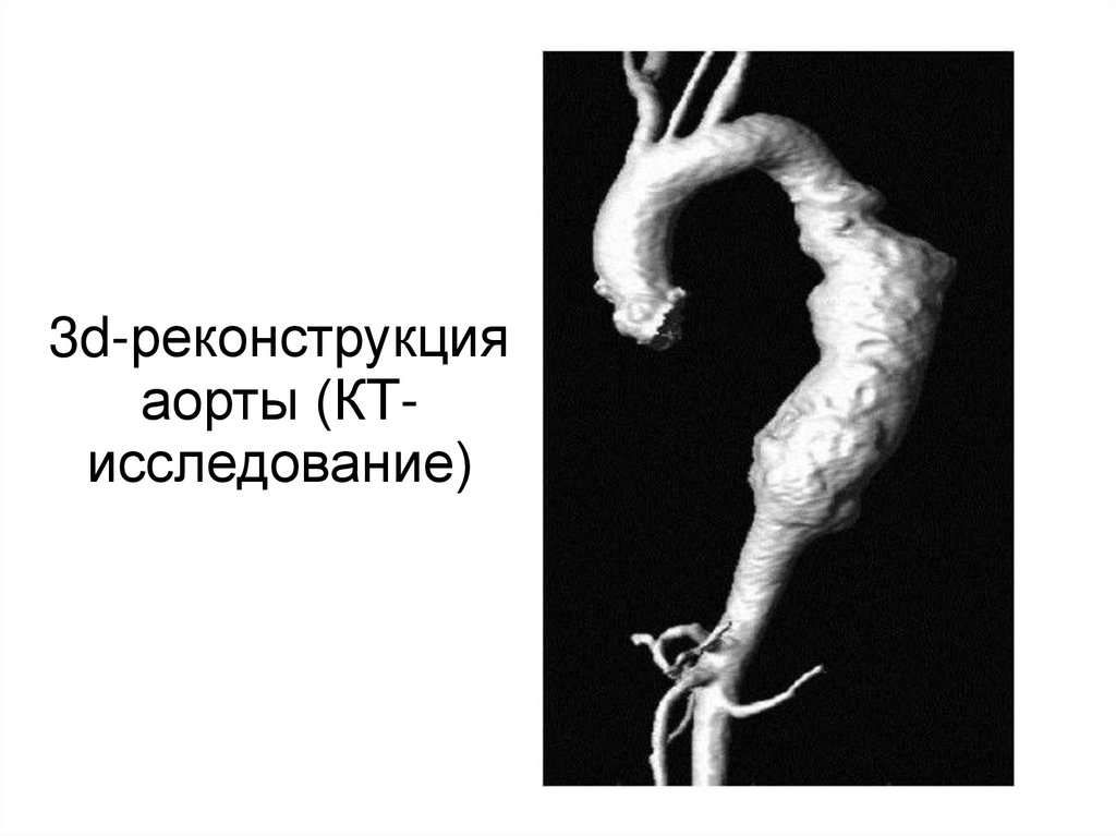 3d-реконструкция аорты (КТ-исследование)