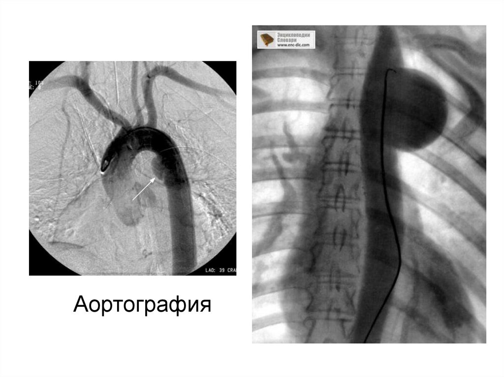 Аортография