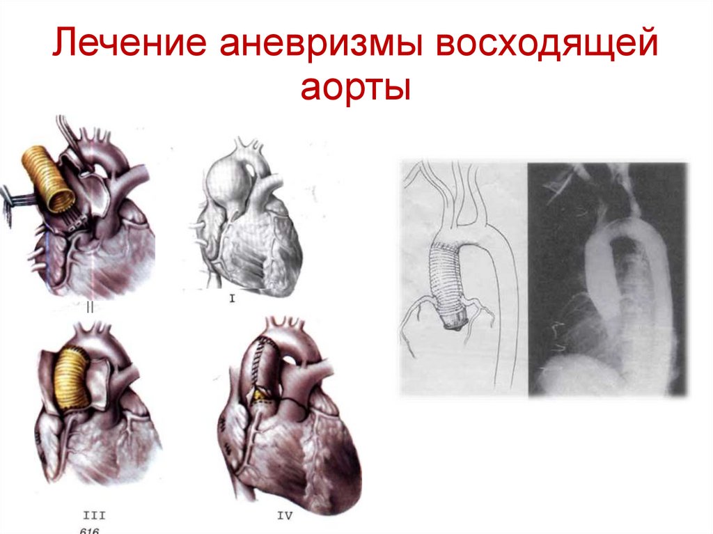 Лечение аневризмы восходящей аорты