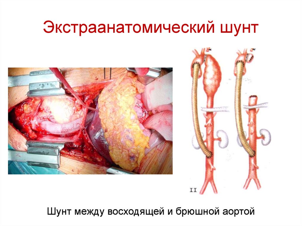 Экстраанатомический шунт