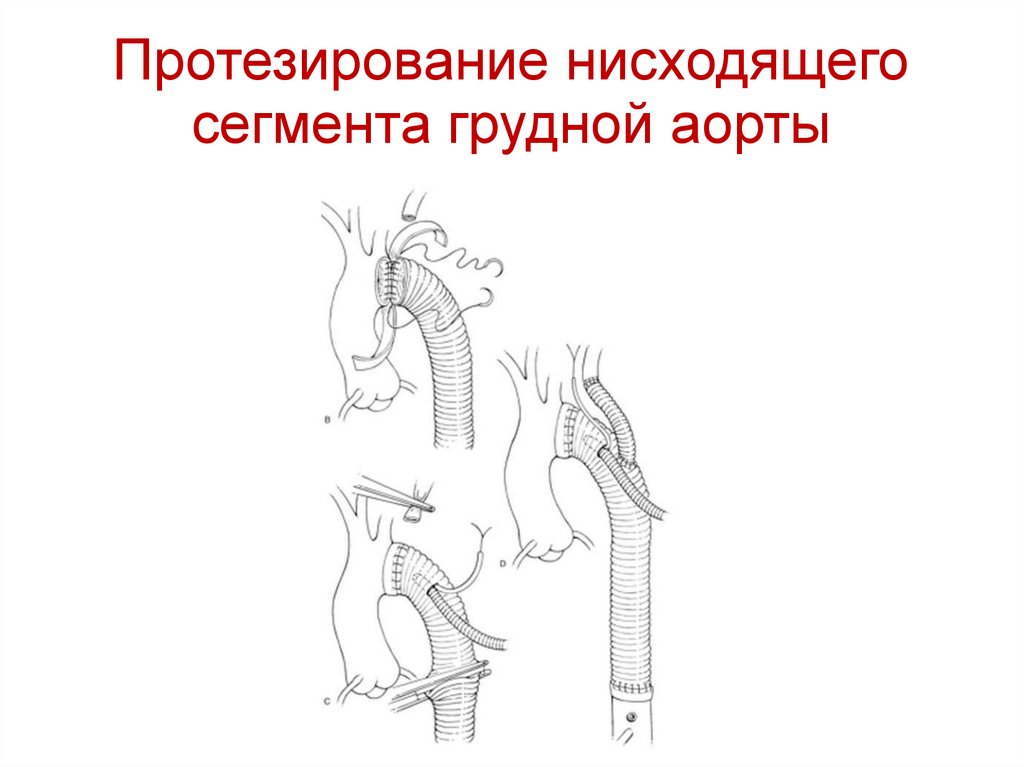 Протезирование нисходящего сегмента грудной аорты