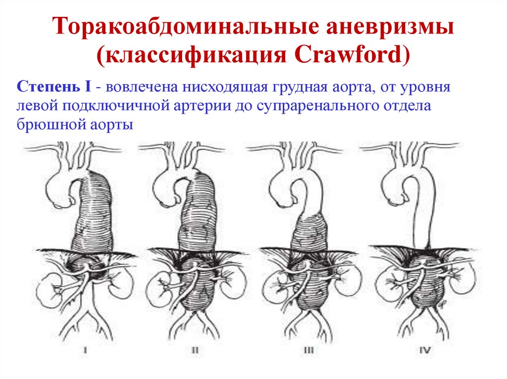 Торакоабдоминальные аневризмы (классификация Crawford)