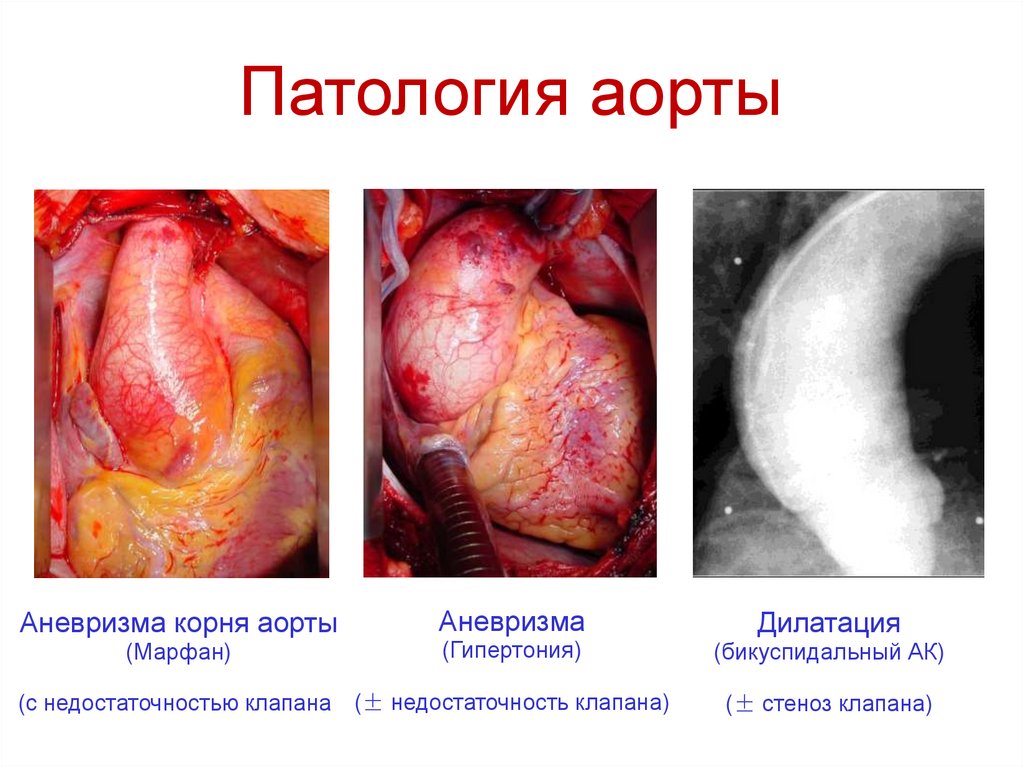 Патология аорты