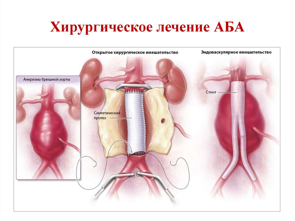 Хирургическое лечение АБА