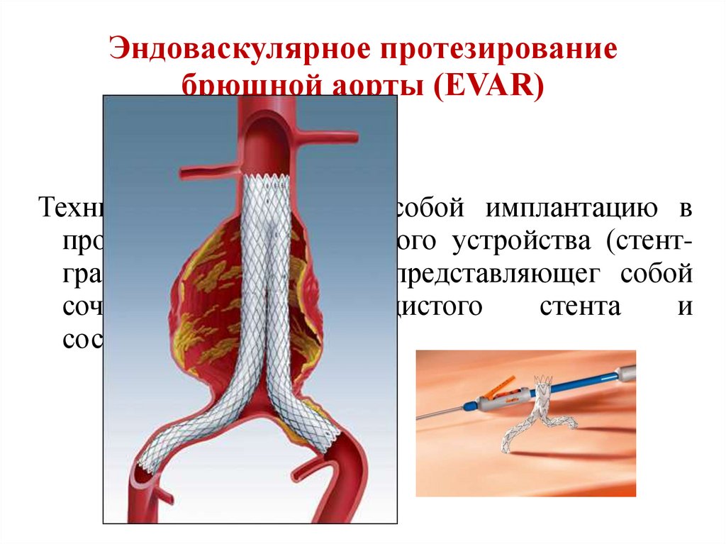 Эндоваскулярное протезирование брюшной аорты (EVAR)